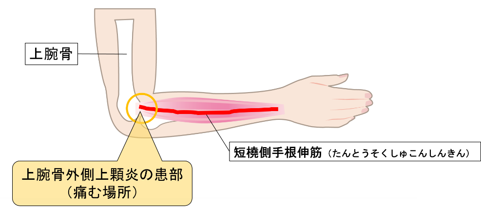 痛い 二の腕 二の腕の内側がピリピリ痛い、こんな症状には注意