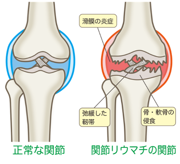 痛い 膝 代 が 10 若いのに、急に膝に違和感や痛みが！「変形性膝関節症」かも。腫れ・水が溜まるときは要注意